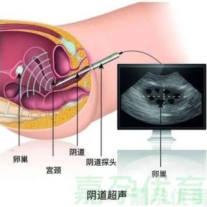 试管取卵，开启新生命的密钥